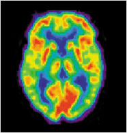 normal pet scan